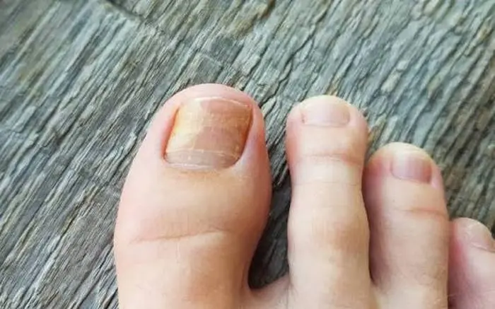 Close-up of a foot with a discolored toenail