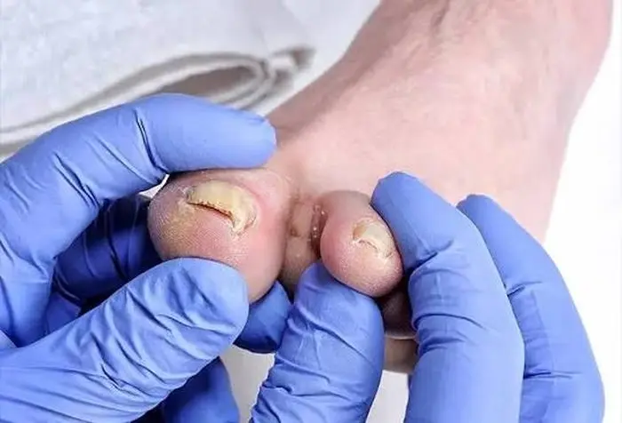 Close examination of toenails showing signs of fungal damage