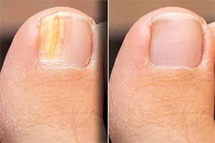 Toenail appearance example